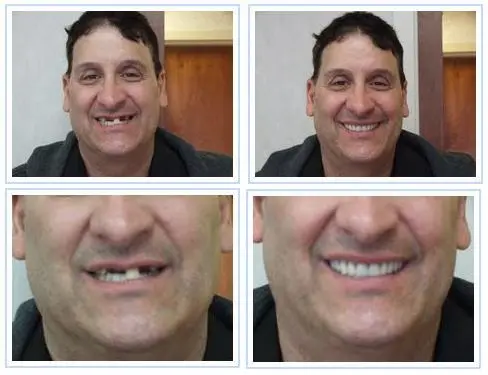 smile gallery case