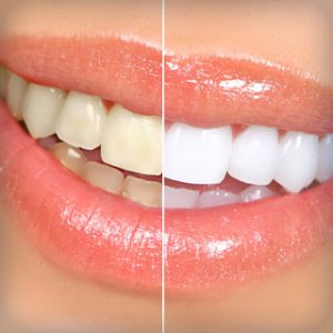 Smile confidently with Zoom! whitening
