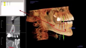 3d imaging can help with the placement of dental implants