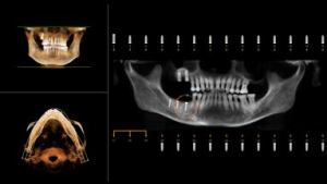 3d imaging can be used to identify areas in the mouth