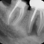x-ray showing infected tooth