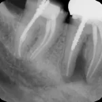 x-ray showing infected tooth