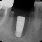 x-ray showing placed implant