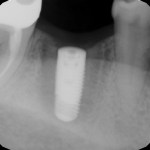 x-ray showing bone integration around implant