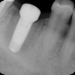 x-ray showing bone integration at a later date