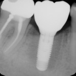 x-ray showing permanent restoration with the implant