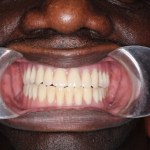 patient with ill-fitting denture
