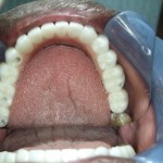 smile replaced with a full set of dental implants on the lower arch