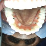 upper arch made up of dental implants
