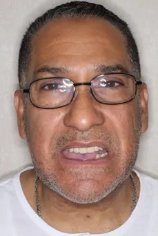 Before Full Mouth Restoration