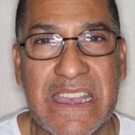 Before Full Mouth Restoration