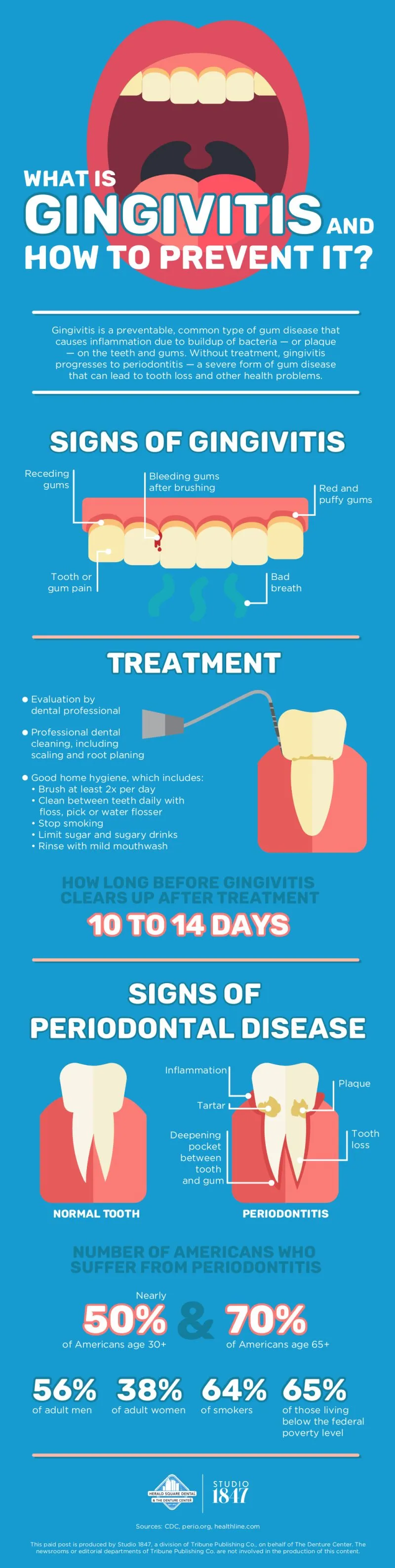What is gingivitis and how to prevent it? | Gingivitis is a preventable, common type of gum disease that causes inflammation due to buildup of bacteria - or plaque - on teeth and gums. Without treatment, gingivitis progresses to periodontitis - a severe form of gum disease that can lead to tooth loss and other health problems. | Signs of gingivitis: receding gums, bleeding gums after brushing, red and puffy gums, tooth or gum pain, bad breath | Treatment: evaluation by dental professional; Professional dental cleaning, including scaling and root planing; Good home hygiene, which includes - brush at least twice per day, clean between teeth daily with floss, pick, or water flosser, stop smoking, limit sugar and sugary drinks, rinse with mild mouthwash; How long before gingivitis clears up after treatment: 10 to 14 days | Signs of periodontal disease: inflammation, plaque, tartar, deepening pocket between tooth and gum, tooth loss | Number of Americans who suffer from periodontitis: nearly 50% of Americans age 30+ and 70% of Americans age 65+, 56% of adult men, 38% of adult women, 64% of smokers, 65% of those living below the federal poverty level