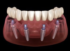 all-on-4 dental implant diagram