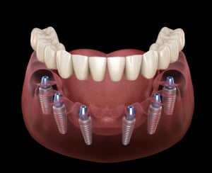 all-on-6 dental implant diagram