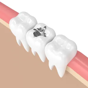 Dental Fillings 2