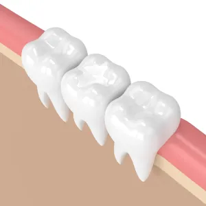 Dental Fillings 1