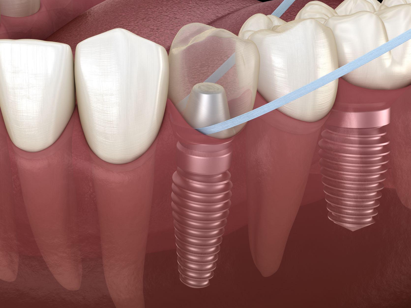 Dental Implant Prophylaxis