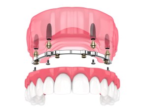 3D Render of Bar Retained Removable Overdenture Installation Supported By Implants