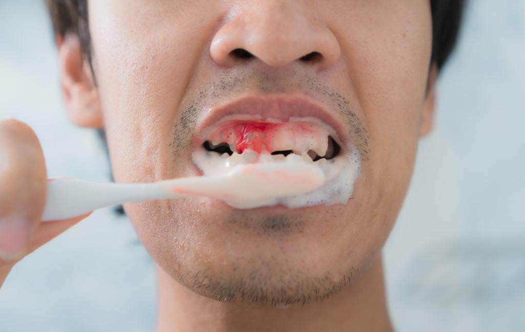 bleeding teeth during brushing toothbrush