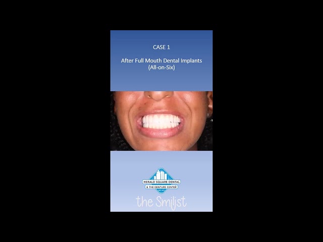 Dental Implant Cases | Herald Square Dental