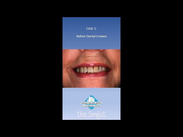 Top Rated Cosmetic Dentist NYC - Before and After Images