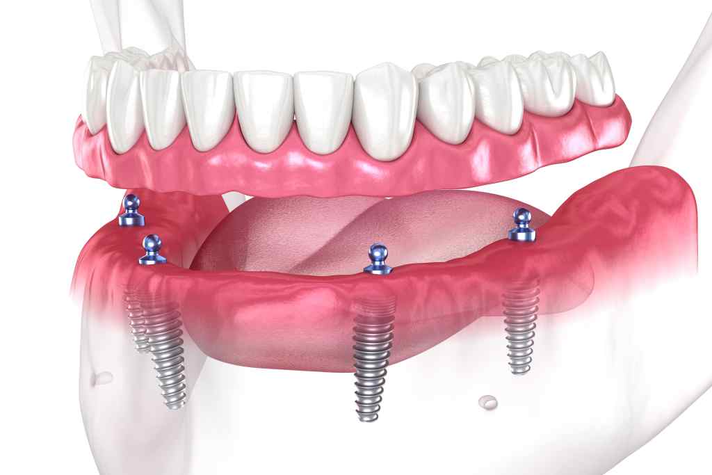 dental prosthesis based on 4 implants