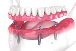 dental prosthesis based on 4 implants